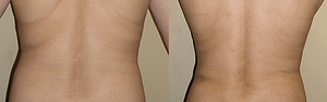 Abdomen, Flanks, and Back liposuction surgery Before & Afte Photos Back