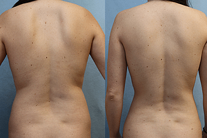 Abdomen and Flanks Liposuction front