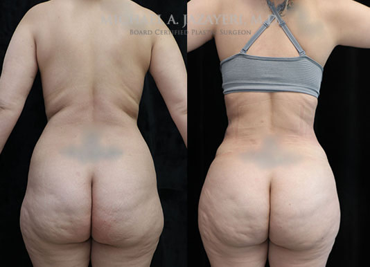 liposuction and fat transfer to buttock