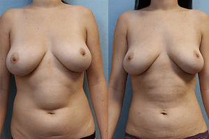 Abdomen and Flanks Liposuction before and after photos - front