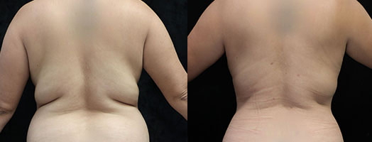 Buttock augmentation before and after