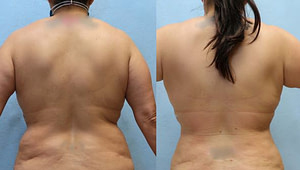 flanks liposuction orange county