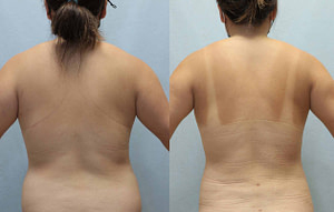 liposuction before and after
