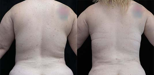 liposuction of flanks