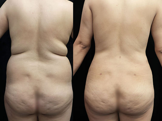 liposuction orange county
