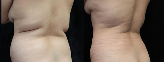 liposuction and fat transfer to butt before and after