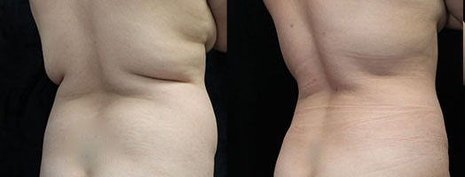 bbl before and after