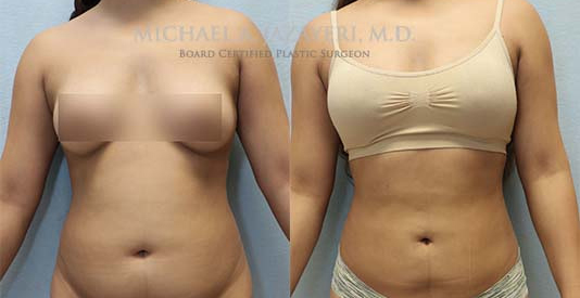Liposuction before and after results front