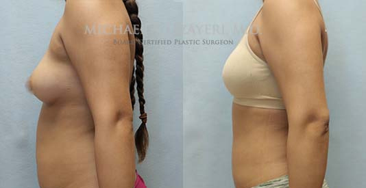 Liposuction before and after results left