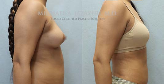 Liposuction before and after results right