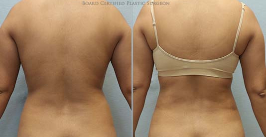 Liposuction before and after results back