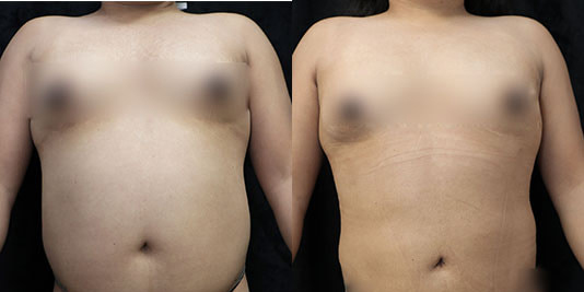 liposuction of abdomen before and after result