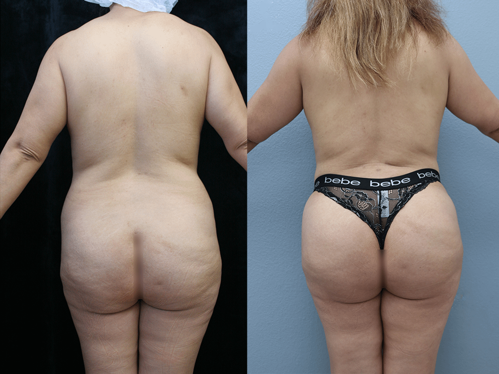 Brazilian Butt Lift Before & After Photos