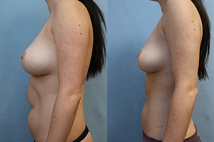 Abdomen and Flanks Liposuction left