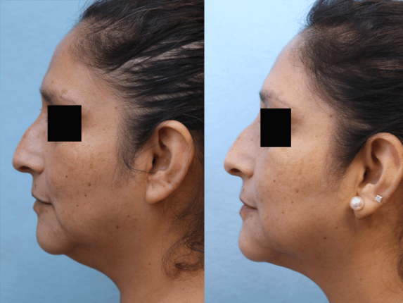 Liposuction Before & After Photos Left Side