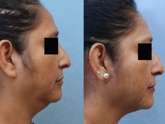 Liposuction Before & After Photos Right Side