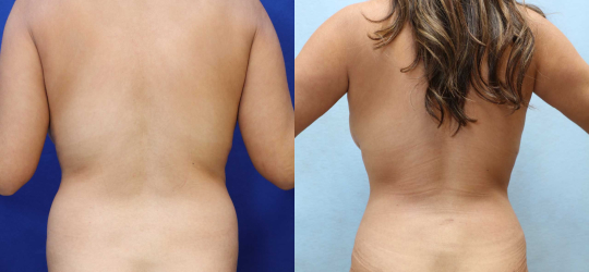 Liposuction Before & After Photos