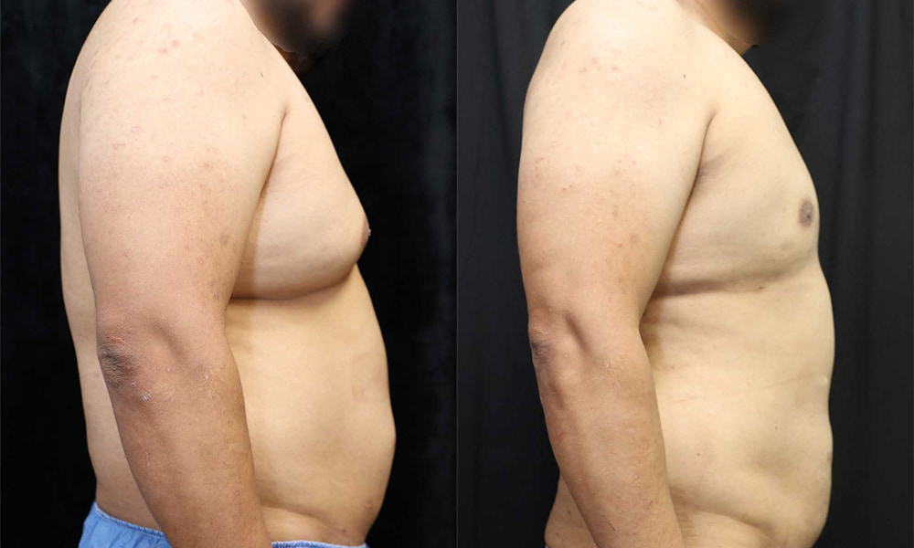 Liposuction Before & After Photos