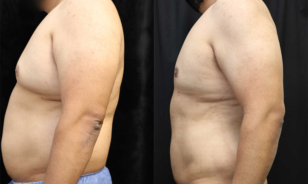 Liposuction Before & After Photos
