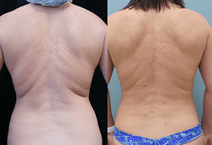 Liposuction Orange County Before & After Photos