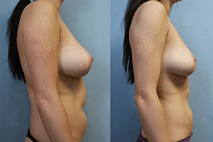 Abdomen and Flanks Liposuction right