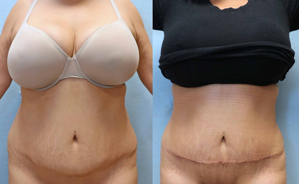 mini tummy tuck orange county front