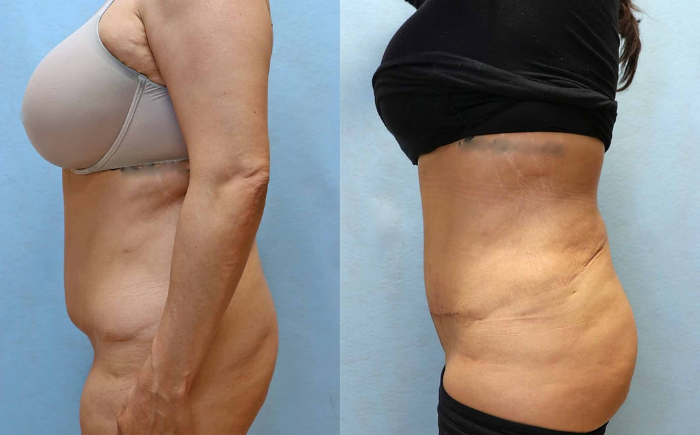 mini tummy tuck before and after left