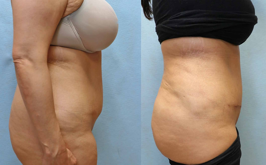 mini tummy tuck orange county before and after