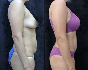 breast augmentation before and after