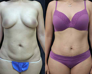 mini abdominoplasty and liposuction of flanks before and after