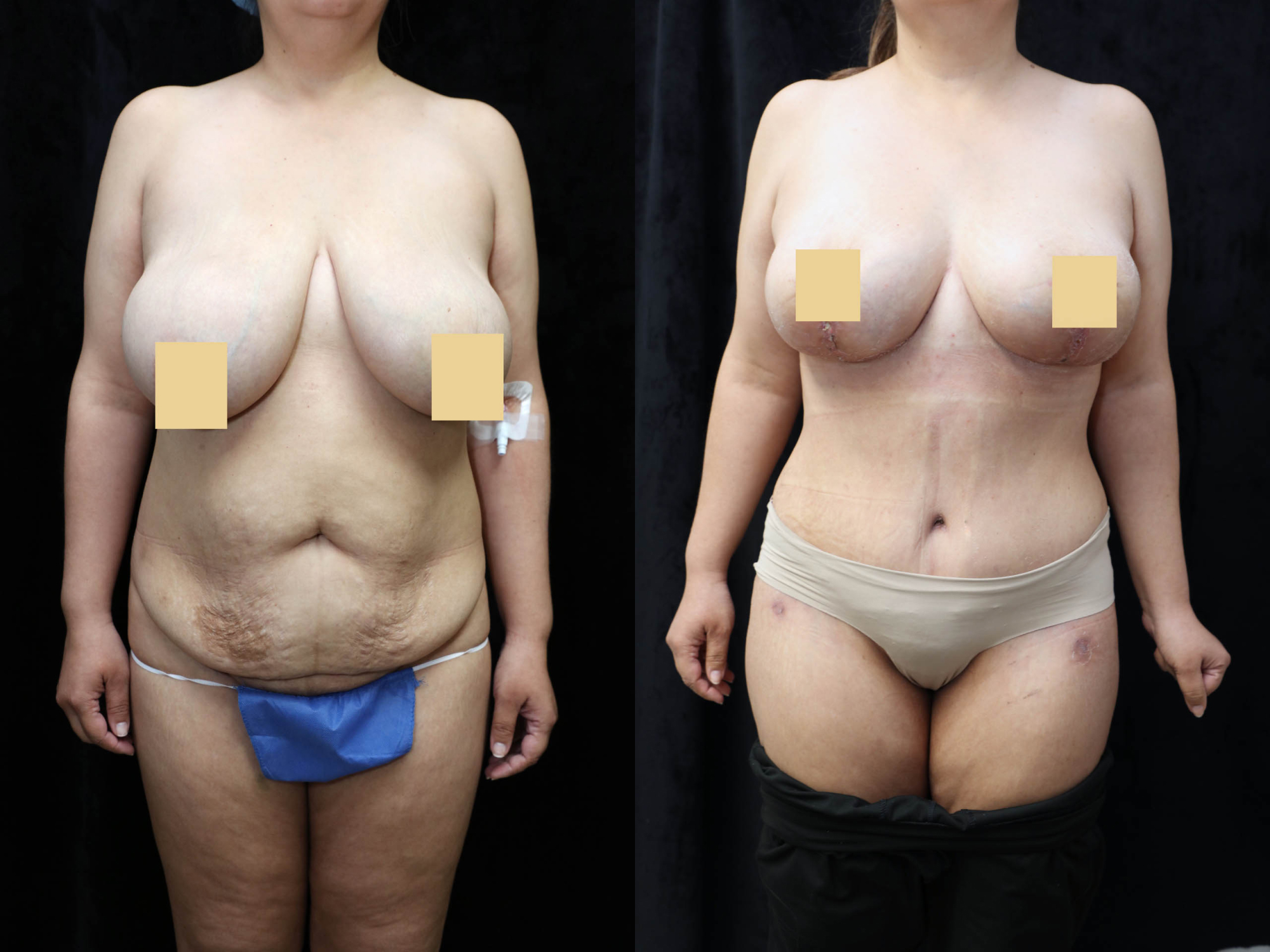 Mommy Makeover Before & After Photos