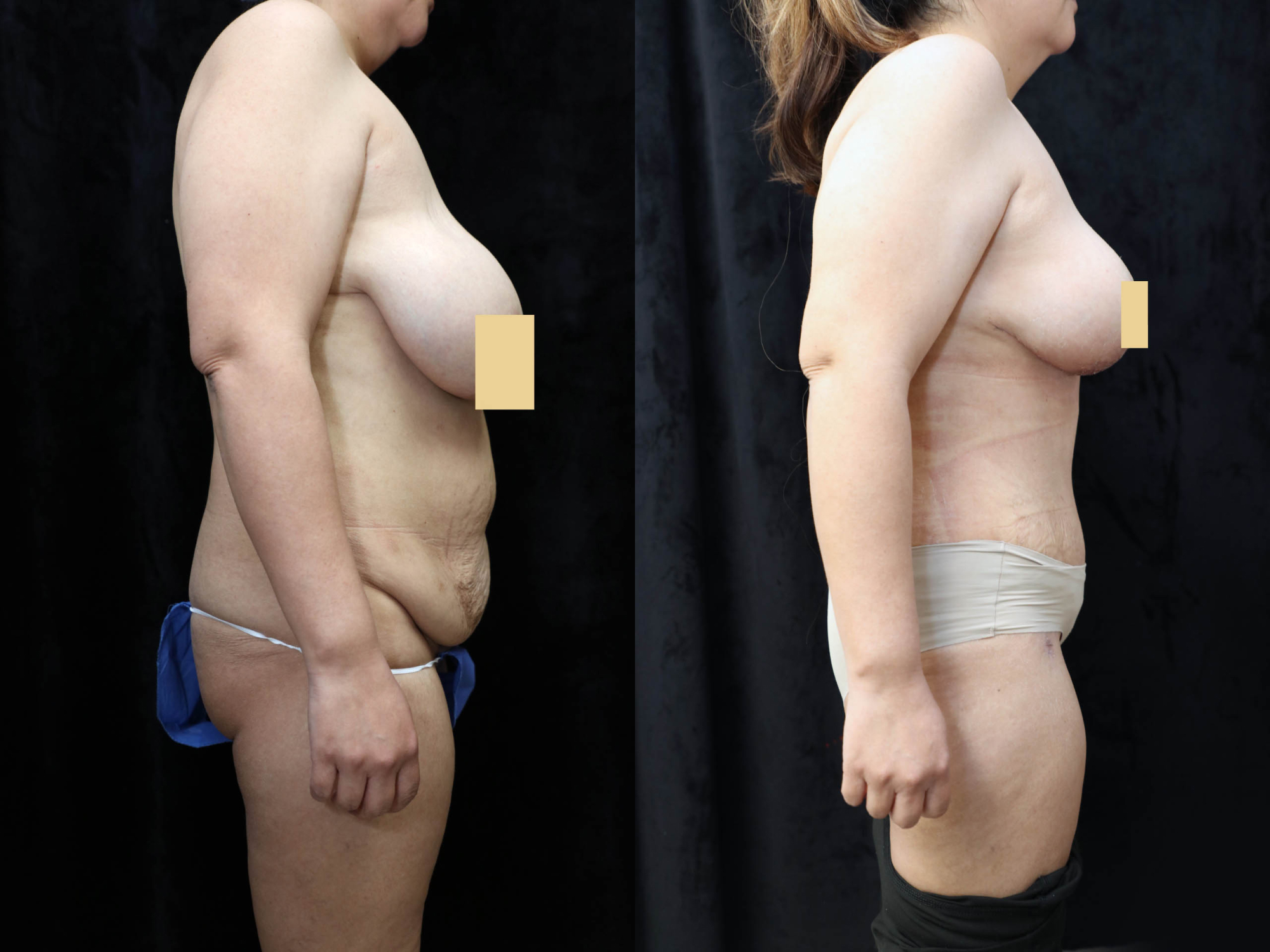 Mommy Makeover Before & After Photos