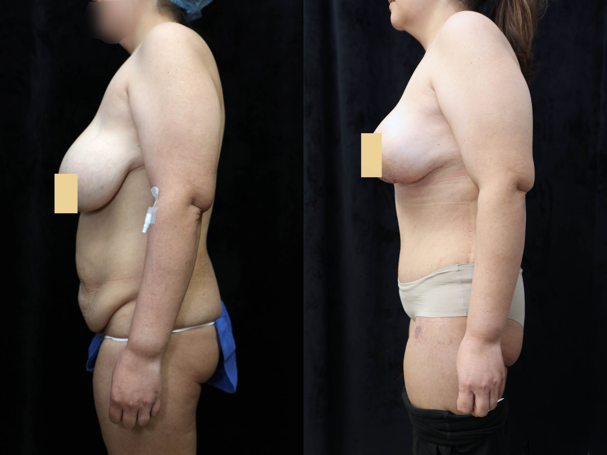Mommy Makeover Before & After Photos