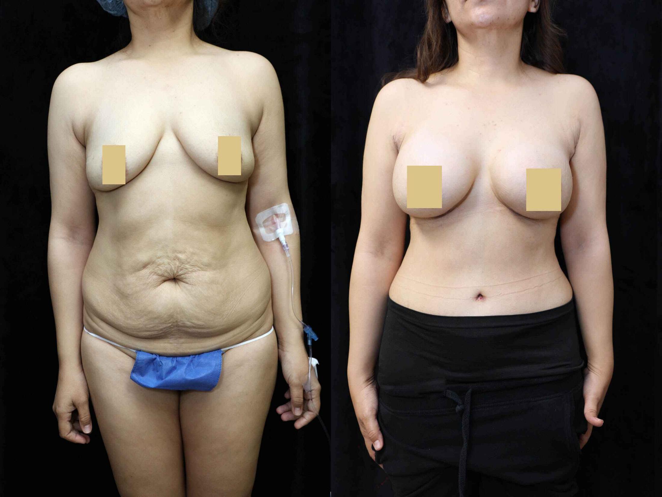 Mommy Makeover Before & After Photos