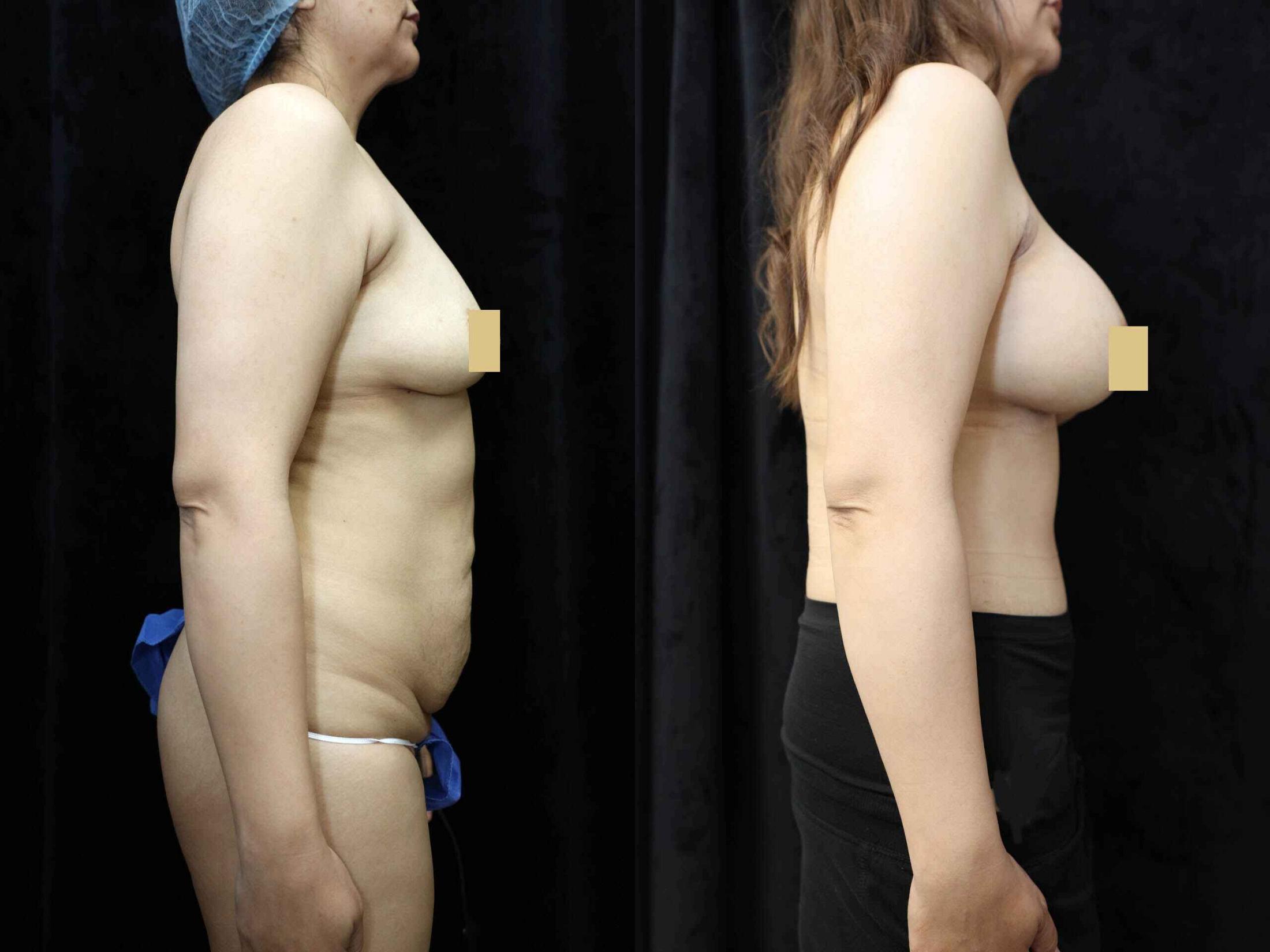Mommy Makeover Before & After Photos