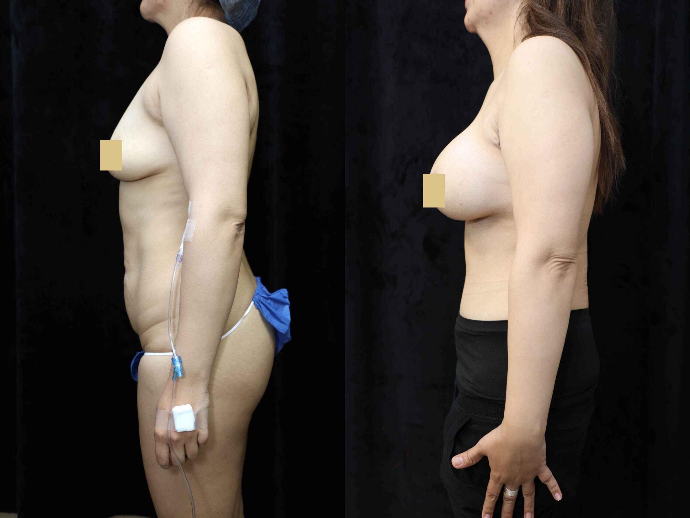 Mommy Makeover Before & After Photos