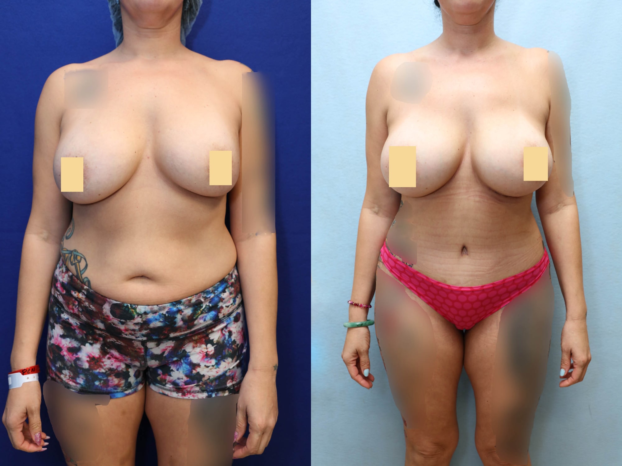 Mommy Makeover Before & After Photos