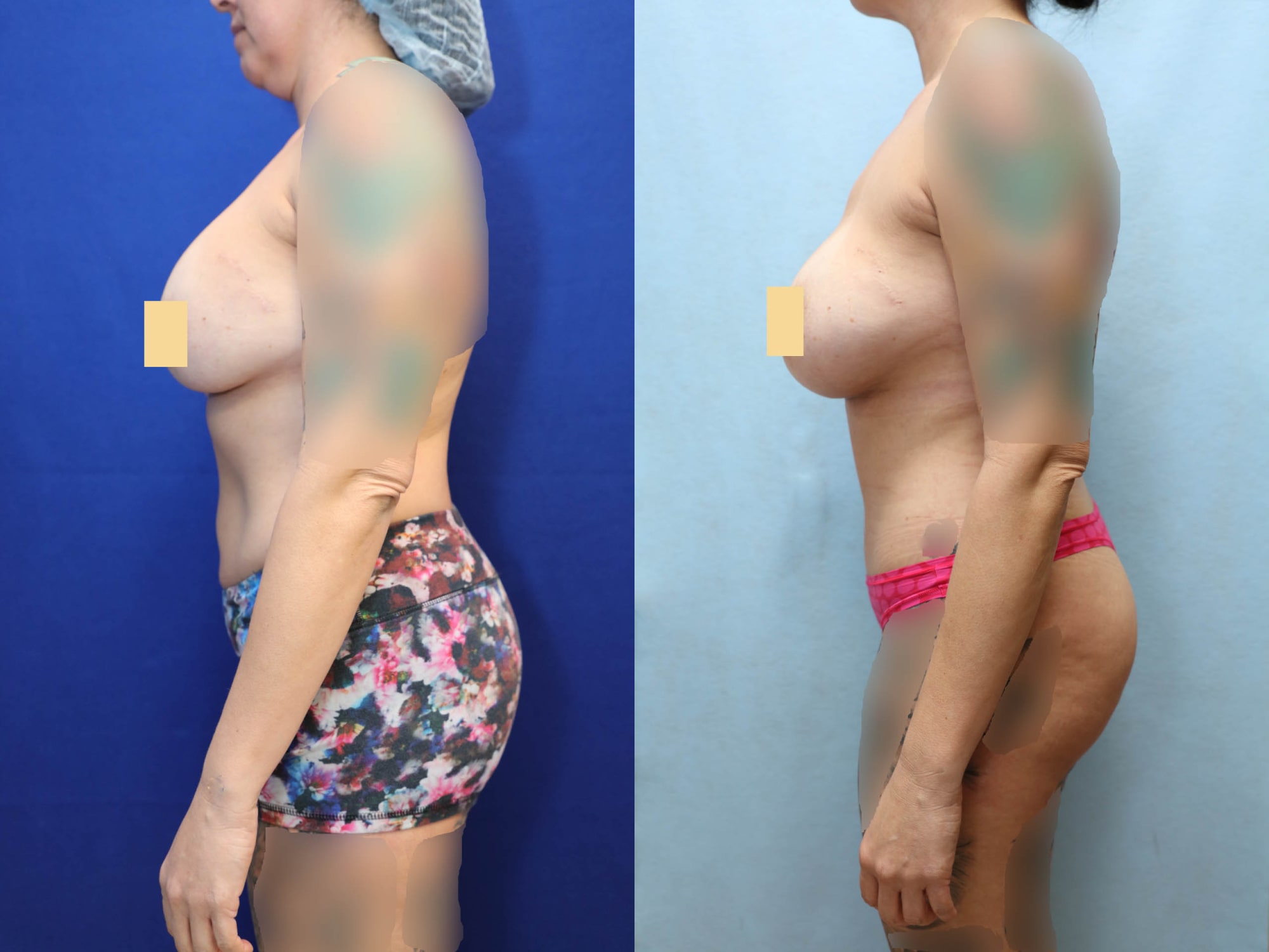 Mommy Makeover Before & After Photos