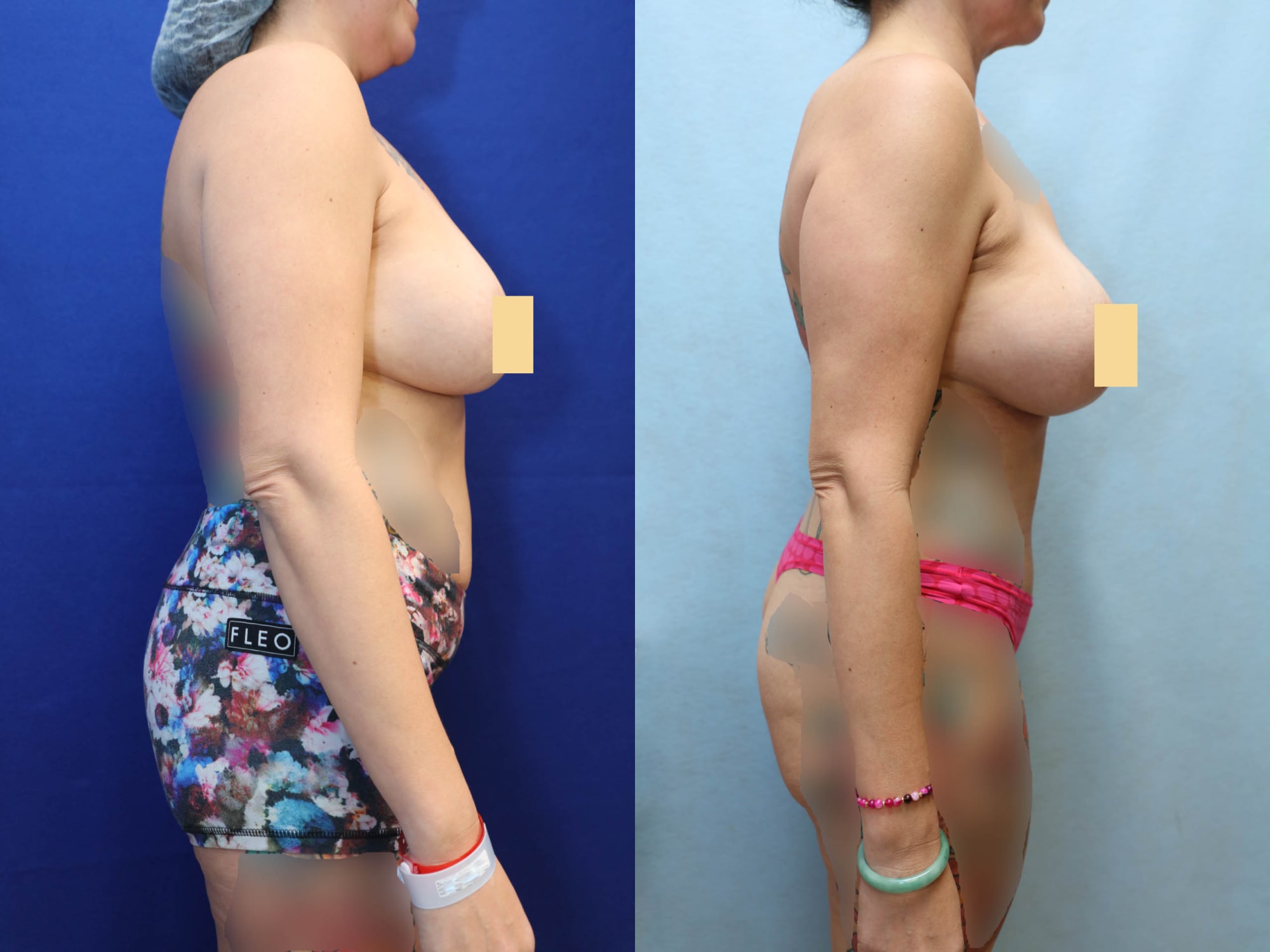Mommy Makeover Before & After Photos