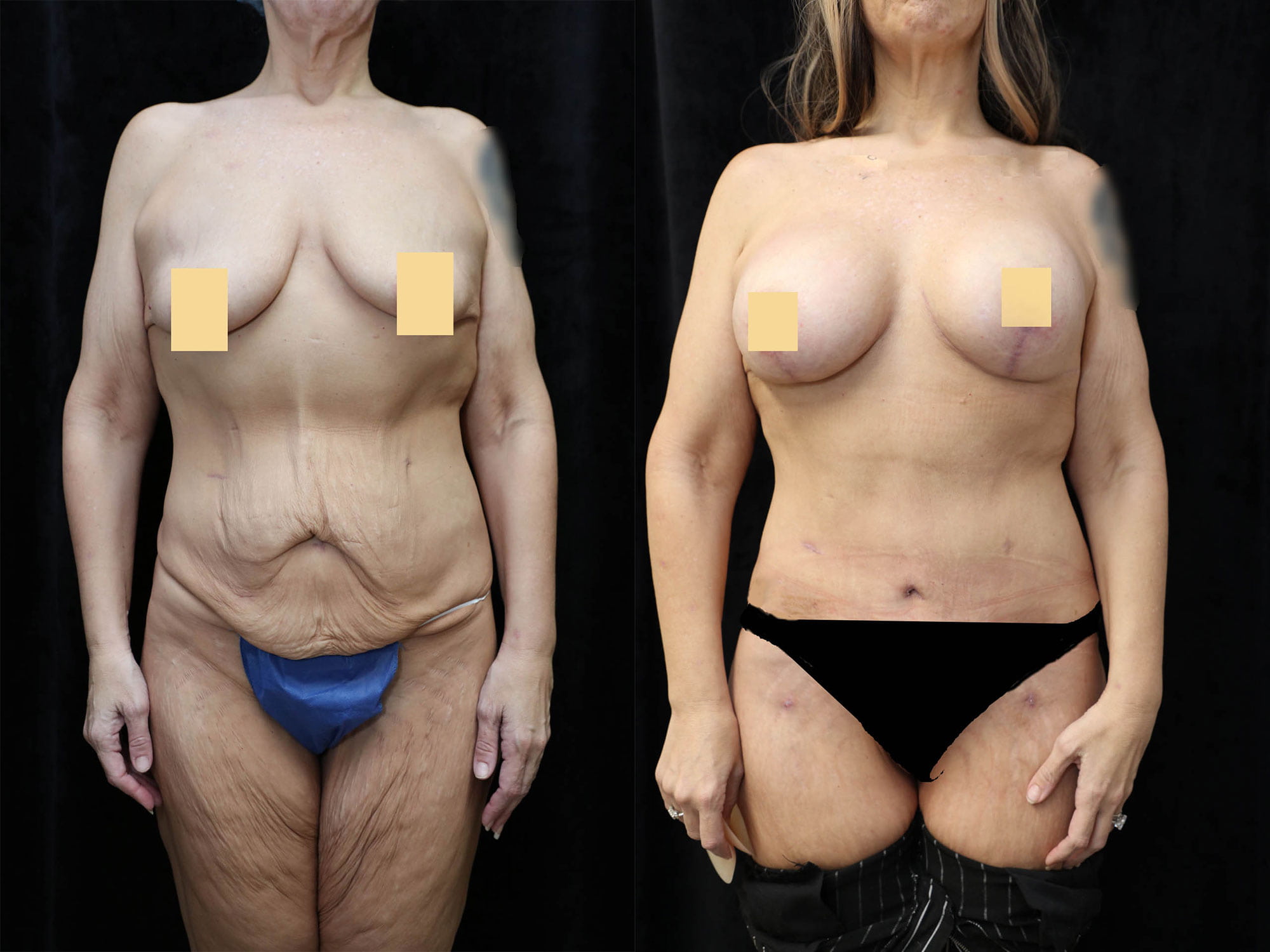 Mommy Makeover Before & After Photos