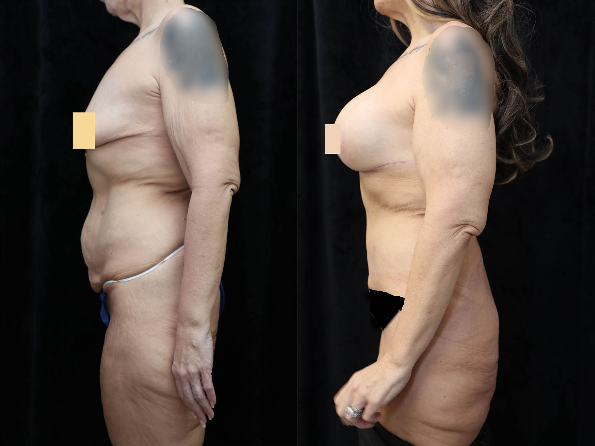 Mommy Makeover Before & After Photos