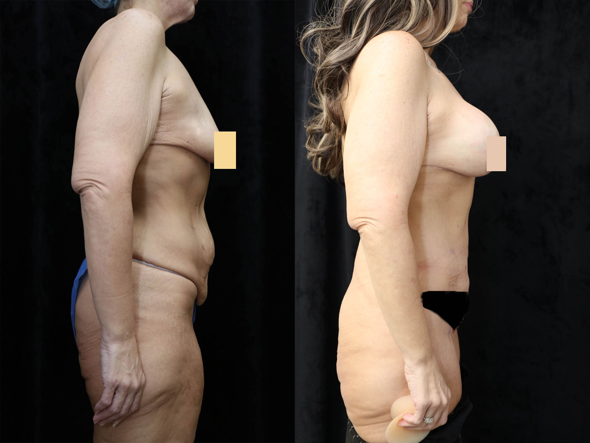 Mommy Makeover Before & After Photos