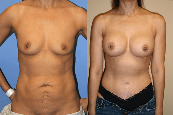 mommy makeover Before & After Photos