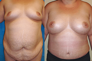 mommy makeover Before & After Photos