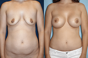 mommy makeover Before & After Photos