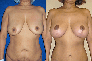Mommy Makeover Before & After Photos Front