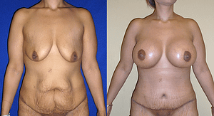 Mommy Makeover Before & After Photos Front