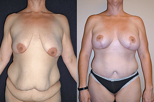 Mommy Makeover Before & After Photos Front