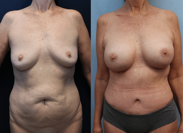 Mommy Makeover Orange County Before & After Photos
