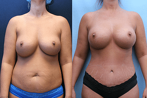 Mommy Makeover Orange County Before & After Photos